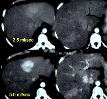 Patient with liver cirrhosis and multifocal HCC injected at 2.5ml/sec (left) and at 5ml/sec (right).